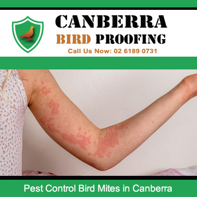 Bird mite skin irritation and bites requiring pest control in Canberra